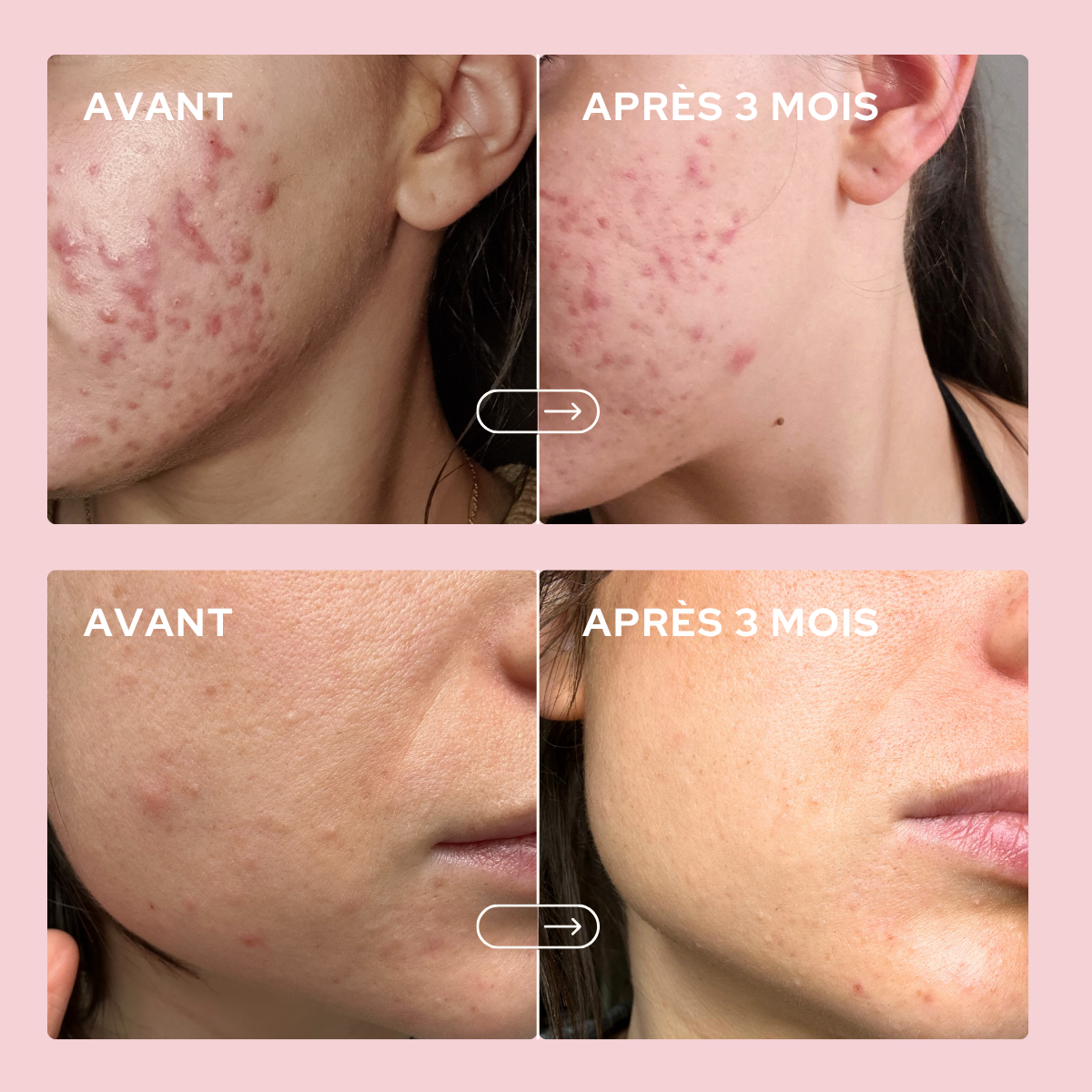 epycure-peau-solaire-gummies-anti-imperfections-1-mois image 4